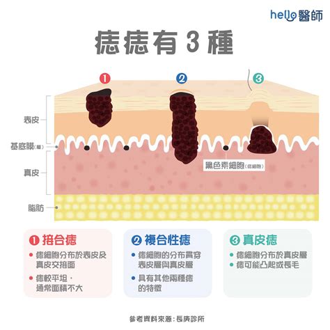 痣的形成原因|痣（黑素细胞痣）